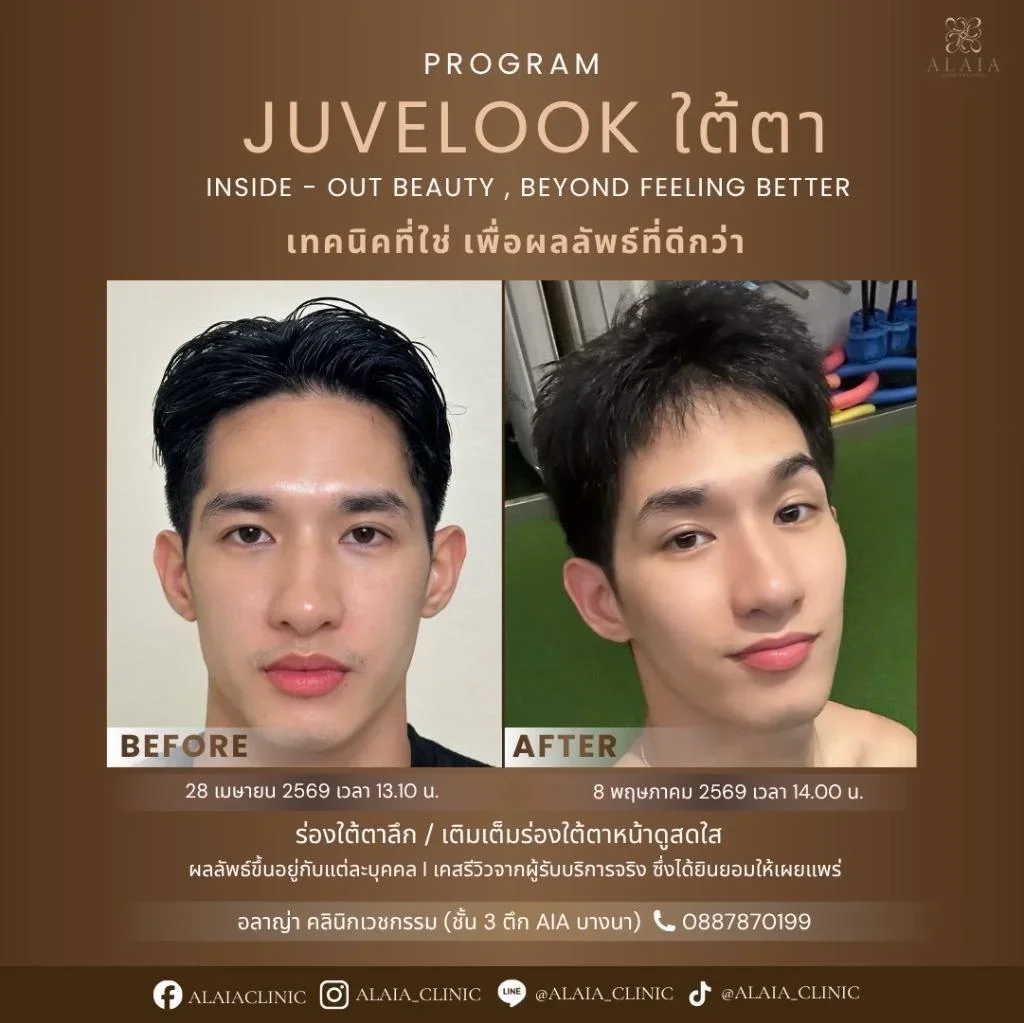 Program Juvelook ใต้ตา Review